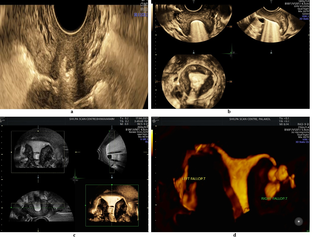 Illustrations of the fallopian tubes on both sides during 3D HyCoSy. (a): 3D HyCoSy showing contrast through complete right tube with spill at fimbrial end as shower sign. (b): 3D HyCoSy showing contrast wrap around the ovary representing ring sign. (c): 3D HyCoSy contrast scan visualizing entire pelvic cavity in a single sweep showing morphological characteristics of uterine cavity, shape of right and left tubes, tubal surface and tube coiling. (d): 3D HyCoSy showing contrast wrap around the right ovary representing hydrosalpinx.