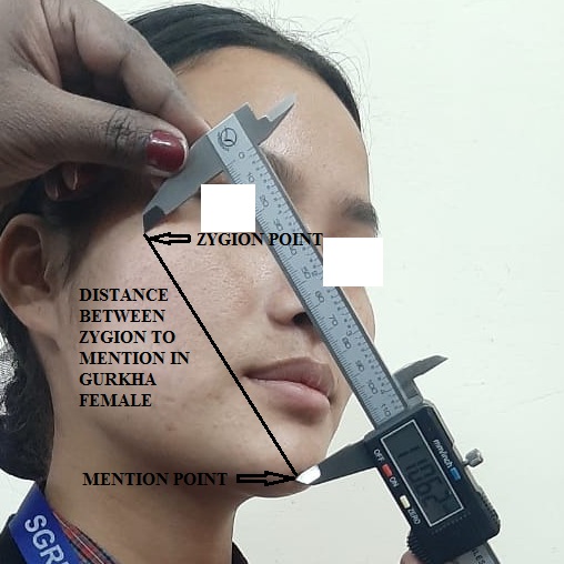 In the study, the reference picture shows the bony landmarks, Zygion to mention distance with the help of digital sliding vernier caliper.