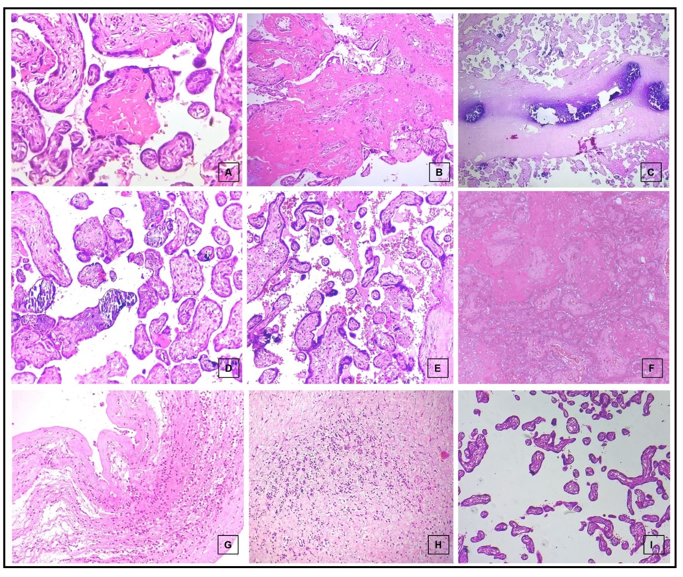 Photomicrographs of hematoxylin and eosin-stained sections showing: fibrotic villi (400x, A and 200x, B), calcified villi (400x, C and 200x D), prominent syncytial knots (100x, E), infarct (200x, F), acute chorioamnionitis (100x, G), funisitis (200x, H) and decreased number of villi for age (200x, I)