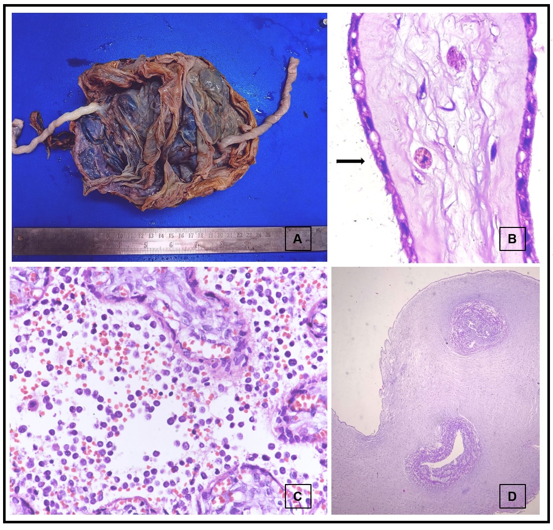 Gross specimen of single case of intra-uterine fetal deaths with diamniotic dichorionic placenta (A). Photomicrographs of hematoxylin and eosin-stained sections showing meconium macrophages (1000x, B), atypical cells of acute promyelocytic leukemia (400x, C) and umbilical cord with two blood vessels (40x, D)