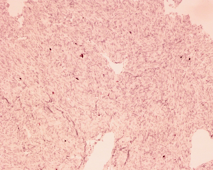 Spindle cell oncocytoma, a misdiagnosed rare entity of the pituitary