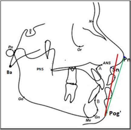 Soft tissue esthetic planes