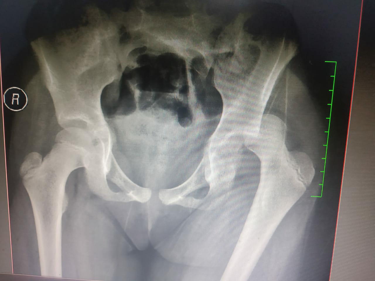 Pre operative radiograph of the pelvis with both hips in anteroposterior view suggestive of left hip posterior dislocation