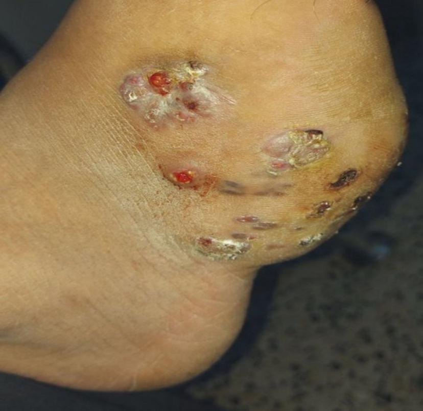 Mycetoma leg showing swelling, abscess and fistula.