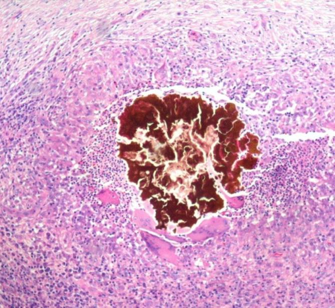 Brown granules of madurella mycetoma in the centre surrounded by giant cells and chronic inflammatory infiltrates (Hematoxylin and Eosin stain, X10).