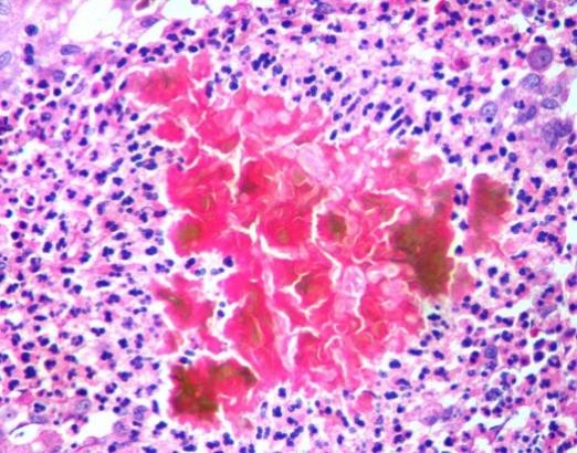 Pinkish brown granules of Actinomadura madurae in the centre surrounded by inflammatory cells (Hematoxylin and Eosin stain, X10).