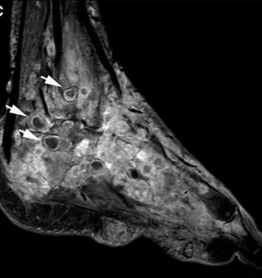 MRI of the foot showing characteristic dot in circle sign (arrow). The high-intensity circles correspond to granuloma and the central low-signal dots correspond to bacterial or fungal grains.