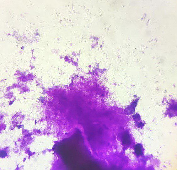 Fine needle aspiration cytology smear showing clumps of filamentous projections of Actinomyces (arrow) (May Grunwald Giemsa Stain, X10).