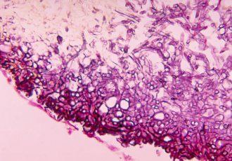 Section showing eumycetoma grains characterized by clusters of branched hyphae arranged radially and forming vacuoles (Periodic acid Schiff stain, X40).