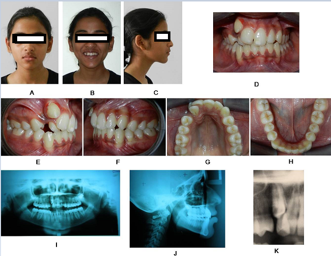 Pre-treatment extra-oral and intra-oral photographs (A-I), radiographs (orthopantomogram-J, lateral cephalogram-K, intra-oral periapical radiograph-L).