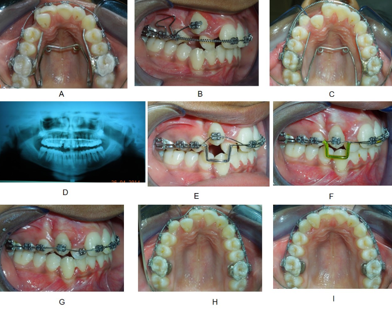 Installation of quad helix (038 blue elgiloy) and 016 thermal NiTi simultaneously (A), compressed open coil spring (0.010”x0.030”) and T-loop (017x025 TMA) (B), Canine retraction completed (C), Mid-treatment orthopantomogram (D). 019x025 stainless steel with step bends and 016 thermal NiTi overlay wire ligated (E-F), 016x022 CuNiTi ligated followed by 019x025 NiTi and 019x025 stainless steel (G-I).