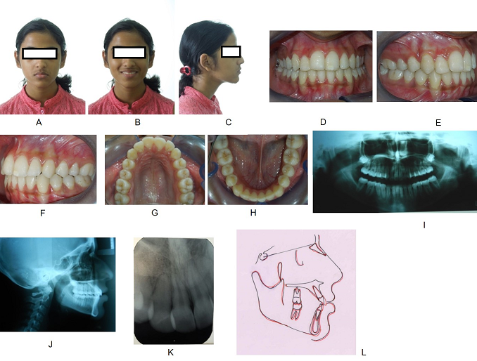 Post-treatment extra and intra-oral photographs (A-H), radiographs (orthopantomogram-I, lateral cephalogram-J, intra-oral periapical radiograph-K), Overall Steiner’s superimposition (L).