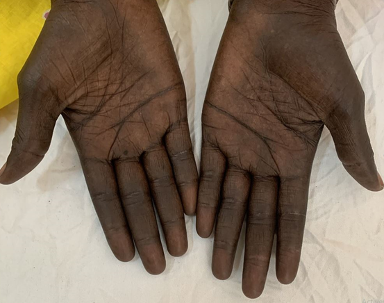 Palmoplantar hyperpigmentation in a patient diagnosed with Graves' disease