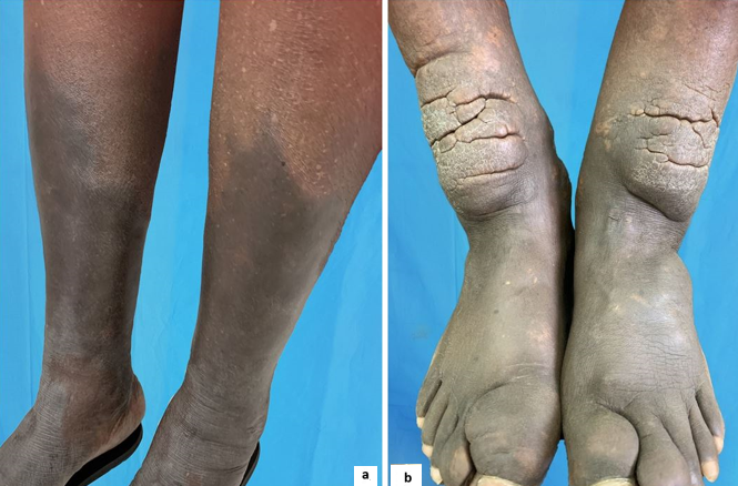 a: Plaque myxedema in a patient diagnosed with Graves' disease; b: Elephantiasis myxedema in a patient diagnosed with Graves' disease.