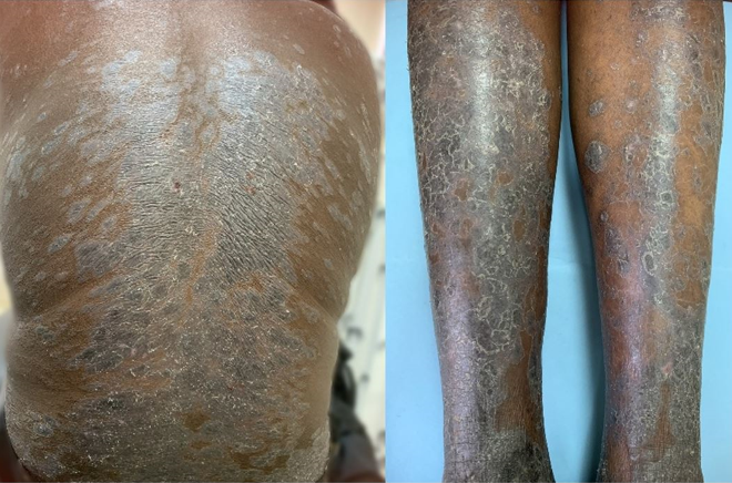 Thiamazole-induced lichenoid toxic epidermal necrolysis in a patient diagnosed with Graves' disease
