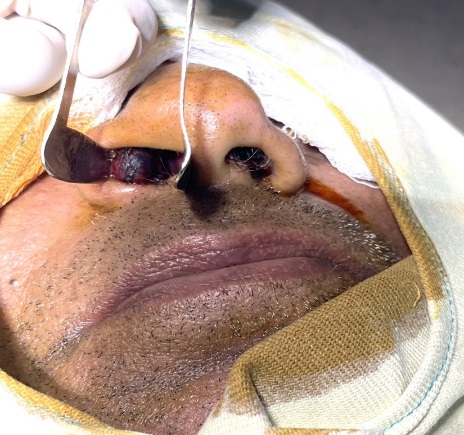 Clinical photograph showing anterior rhinoscopy picture of the lesion in the right nasal vestibule.