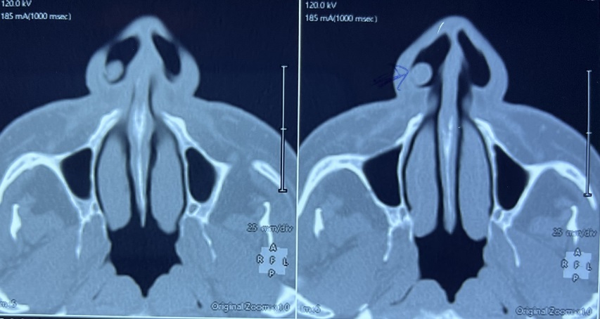 Axial sections of plain CT scan Nose and Paranasal sinuses showing a mass in the right nasal vestibule area.