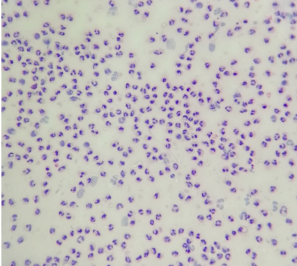 Centrifuged smear shows predominance of neutrophils – Acute Inflammation.