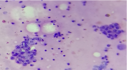 Centrifuged smear shows reactivemesothelial cells in background of lymphocytes.