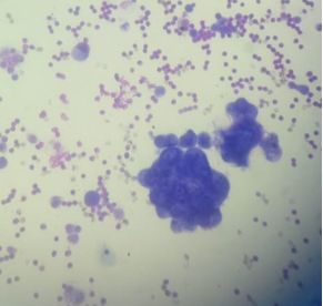 Centrifuged smear shows three dimensional ball formation in metastatic adenocarcinoma.