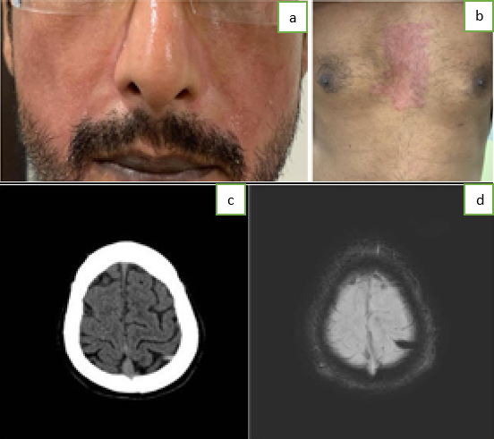 A:Malar rash with thickened skin; B: Rash on anterior chest wall; C: CT Brain showing the “Cord” sign in the left parietal lobe, indicating a thrombosed cortical vein; D: Susceptibility Weighted Imaging MRI Brain showing hypointense lesion suggestive of thrombosed cortical vein
