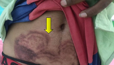 Dermatophyte infection in Pediatric patient