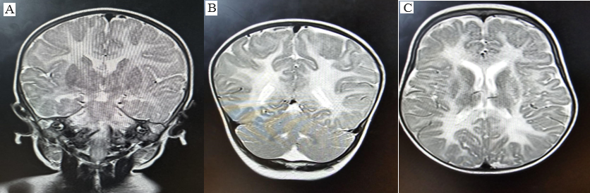 A, B and C show Coronal and Axial T2WI showing a lack of white matter volume along with bilaterally symmetrical T2/FLAIR hyperintensity involving periventricular and subcortical white matter of bilateral cerebral hemispheres with involvement of subcortical u-fibers and internal capsule. 