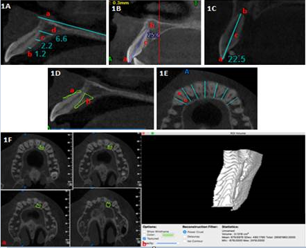 Assessment of alveolar bone thickness in sagittal plane of MPR section of CBCT. (a) Palatal plane, (b) Cervical level thickness, (c) Mid root level thickness, (d) Apical level thickness; 1B: Assessment of tooth length in sagittal plane of MPR section of CBCT. (a) Incisal tip, (b) Root apex, (c) length of tooth; 1C: Assessment of tooth length (resorbed) in sagittal plane of MPR section of CBCT. (a) Incisal tip, (b) mid-point of resorbed root apex, (c) length of tooth with resorbed root apex; 1D: Region of Interest (ROI) selection using HorosTM software for assessment of alveolar bone mean area in sagittal plane. (a) ROI on buccal side, (b) ROI on palatal side; 1E: Maxillary anterior region in axial section divided into six segments using blue line (imaginary line perpendicular to cortices), sub-divided into (a) buccal sub-segment.
