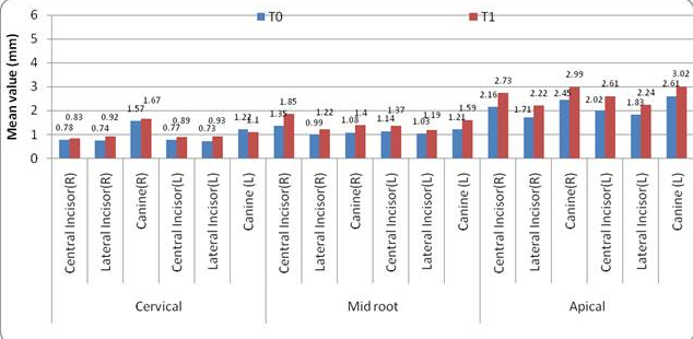 Change in alveolar bone thickness on buccal side