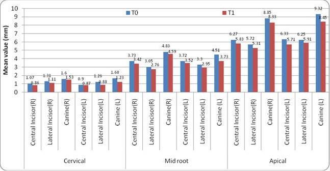 Change in alveolar bone thickness on palatal side