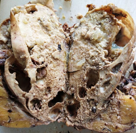 Cut section of the nephrectomy specimen shows a gray-white necrotic growth involving the whole renal parenchyma.
