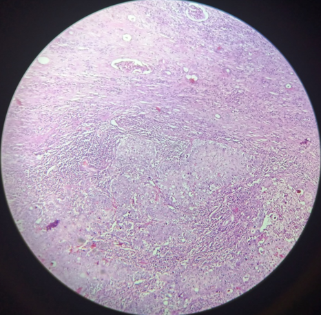 Photomicrograph shows nests of squamous cells and residual renal tubules. (H&E, 10X)