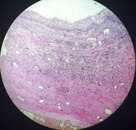 Photomicrograph shows squamous metaplasia of urothelial lining. (H&E, 10X)