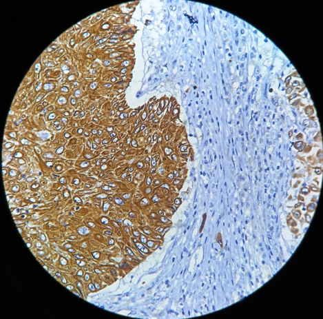 Photomicrograph shows strong cytoplasmic staining of squamous cells. (IHC-AEI/AE3, 40X)