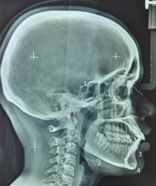 Cephalometric landmarks used (1- Sella, 2- Nasion, 3- Point B, 4- Menton, 5- Gonion, 6-Articulare)