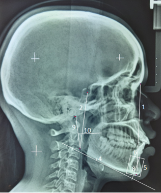Cephalometric Parameters used (1. Anterior facial height, 2. Posterior facial height, 3. Jarabak’s ratio, 4. Antegonial notch depth, 5. Symphysis height, 6.Symphysis depth, 7. Symphysis ratio, 8. Symphysis angle, 9. Ramus height,10. Ramus width)