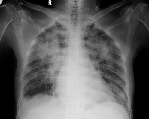 B/L non homogenous opacity more in the right side (Mycoplasma case)