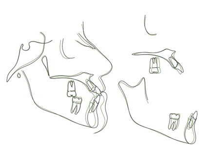 Superimposed lateral cephalometric tracings before treatment and after treatment.