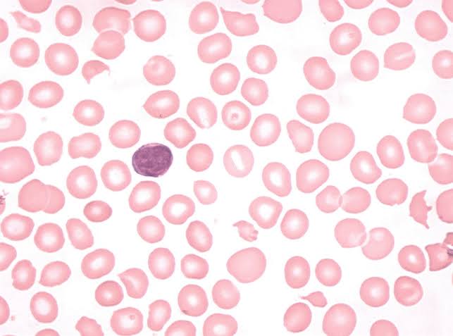Showing thrombocytopenia and anemia in peripheral blood smear