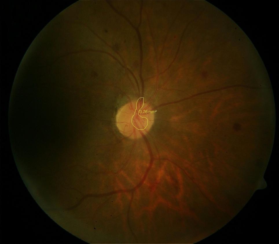 Shows the area of NVD of size 0.76mm2 before any laser photocoagulation 