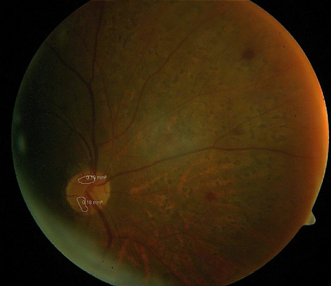 Shows that the area of NVD partially regressed to 0.37mm2 post 3 months PRP
