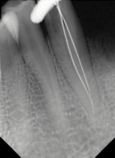 Working length radiograph