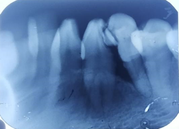 Pre-operative radiograph