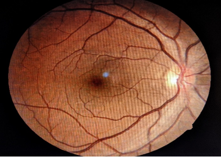 The Right eye (Figure 3) had clear media, normal disc and foveal reflex.