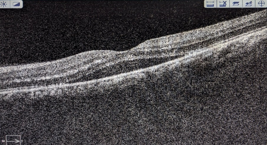 On 2nd week follow up the lesion (Figure 5)