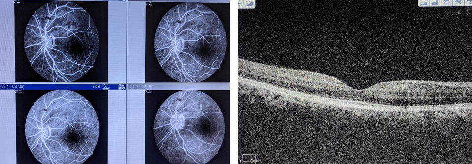 The Patient was reviewed every week for another 2 weeks. Every visit fundus photo was documented. BCVA of left eye improved from 6/36 to 6/6(Figure 6). Left eye fundus, OCT and FFA were noted to be normal.