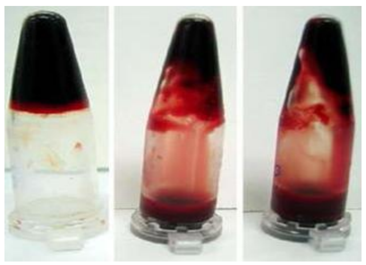 Clot-lysis of blood samples of normal subjects (Positive control, negative control and extract)