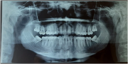 OPG showing angulated molars