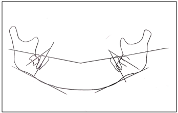 Tracing of OPG with premolar extraction