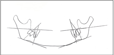 Tracing of OPG with premolar extraction